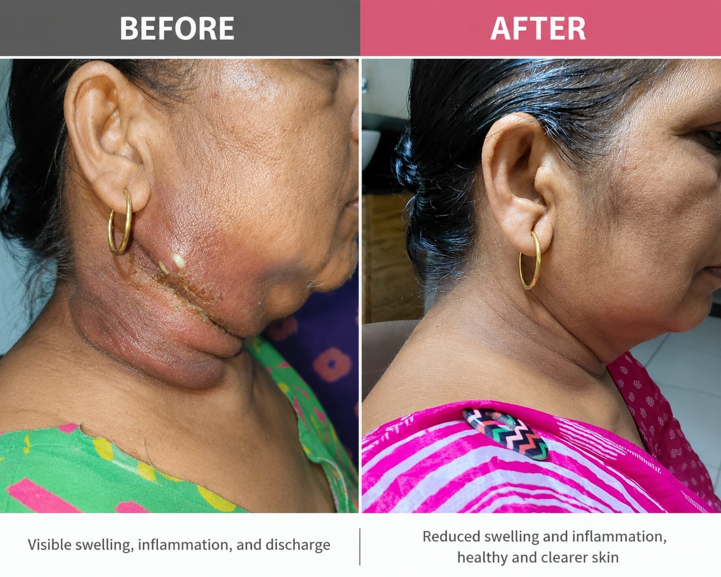 Successful Treatment Despite Diabetes Mellitus